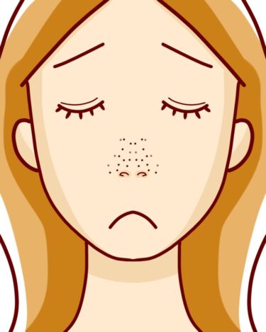 いちご鼻、毛穴の黒ずみには自分にあったクレンジングが重要？？